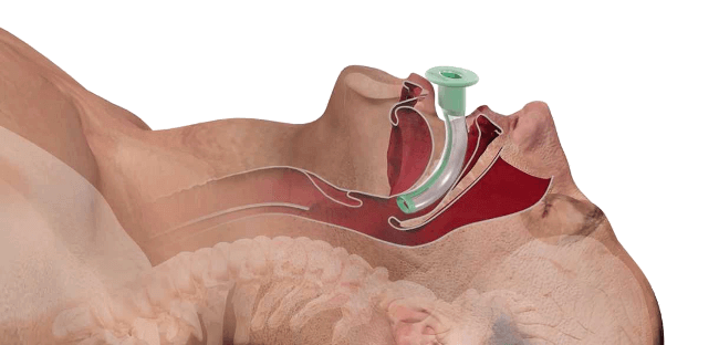 Airway